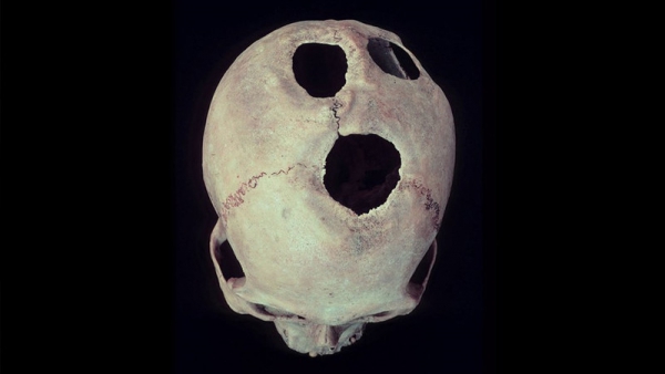 В Китае трепанацию черепа делали более 3,5 тысяч лет назад